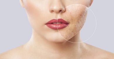 Types of Acne. What should you know about