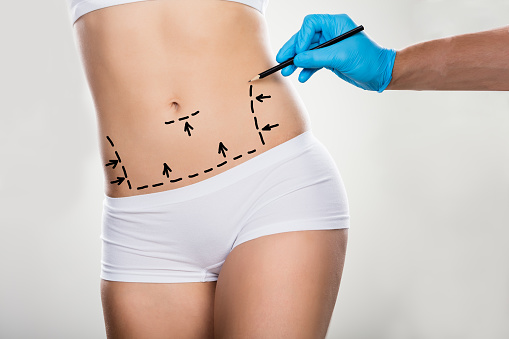 Recovering From Liposuction: Here's What To Expect