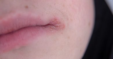eczema on your lips
