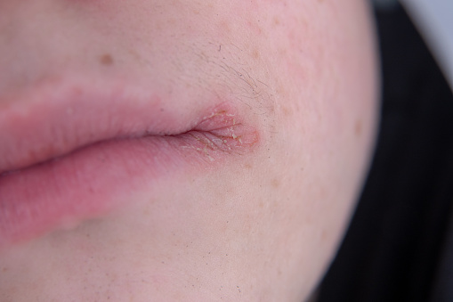 eczema on your lips
