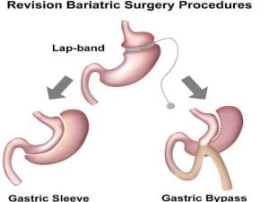 Gastric Sleeve Revision Surgery's Positive Effects