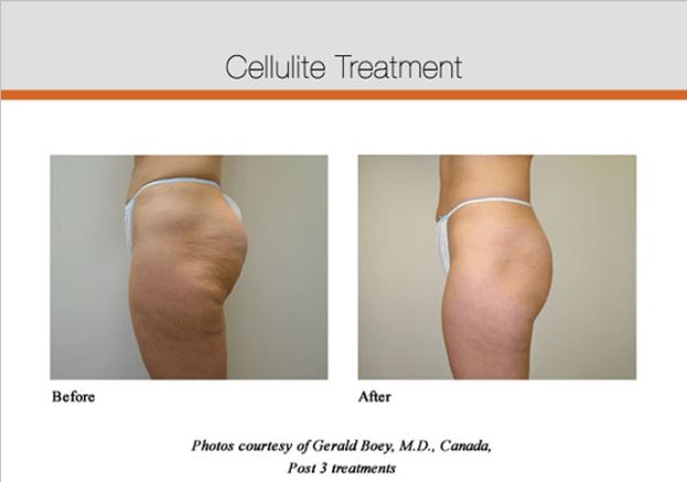 Discover the True Cost of Velashape III Cellulite Reduction