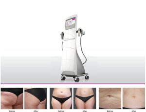 cellulite