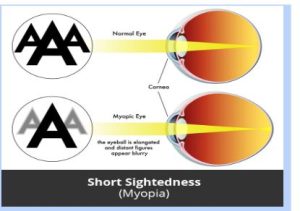 eye