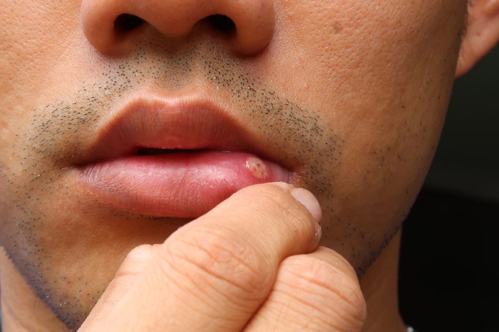 canker sore